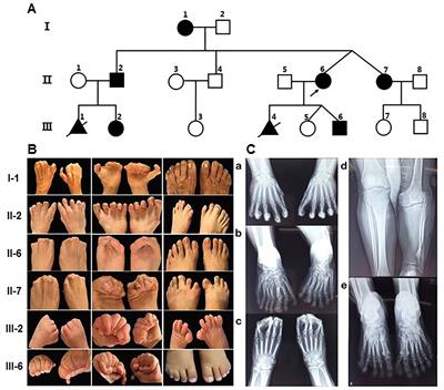 Sub-Exome Target Sequencing in a Family With Syndactyly Type IV Due to a Novel Partial Duplication of the LMBR1 Gene: First Case Report in Fujian Province of China